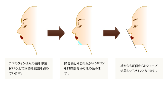 FBC式顎（アゴ）の美容形成術 イメージ図